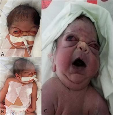 Compound heterozygous FAM20C gene variants in a patient with severe Raine syndrome: a case report